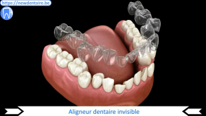 Gouttière pour alignement transparente